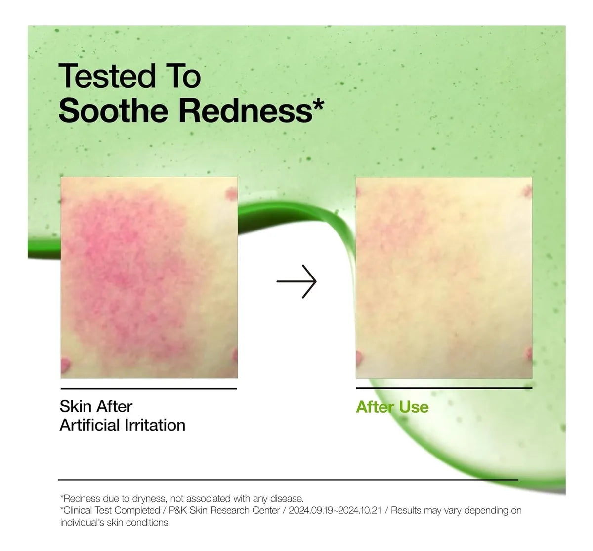 Anua Azelaic Acid 10 Hyaluron Redness Soothing Serum (30 ml)